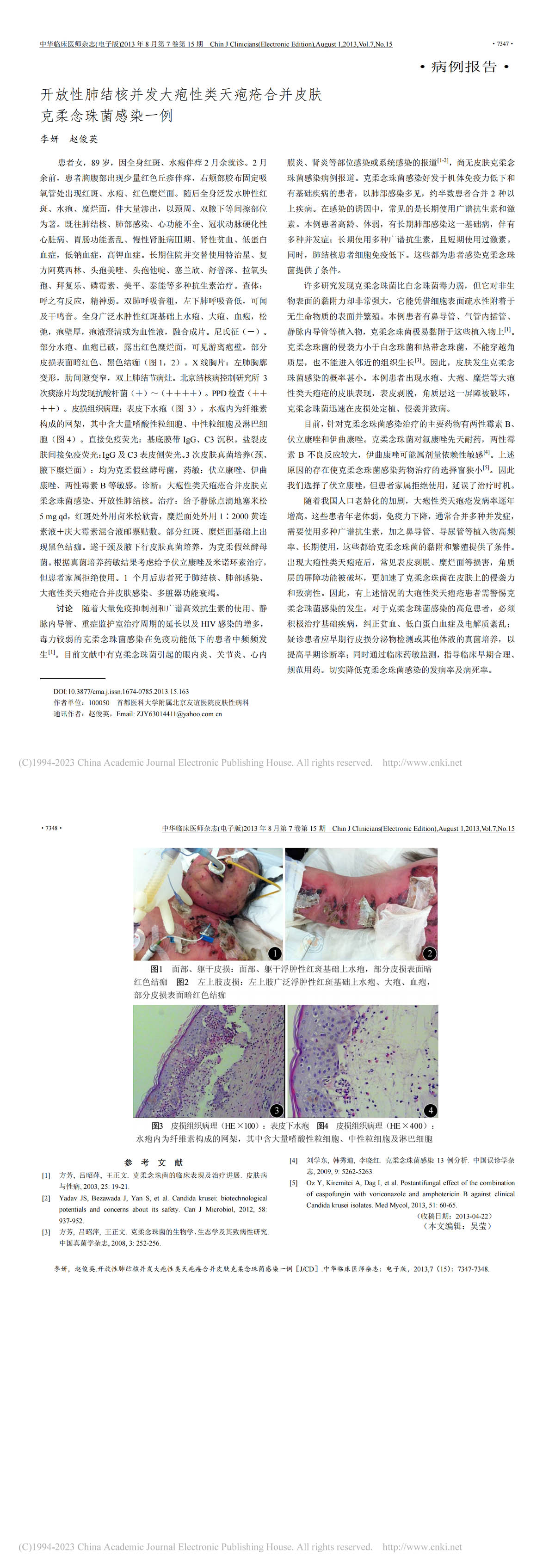 开放性肺结核并发大疱性类天疱疮合并皮肤克柔念珠菌感染一例