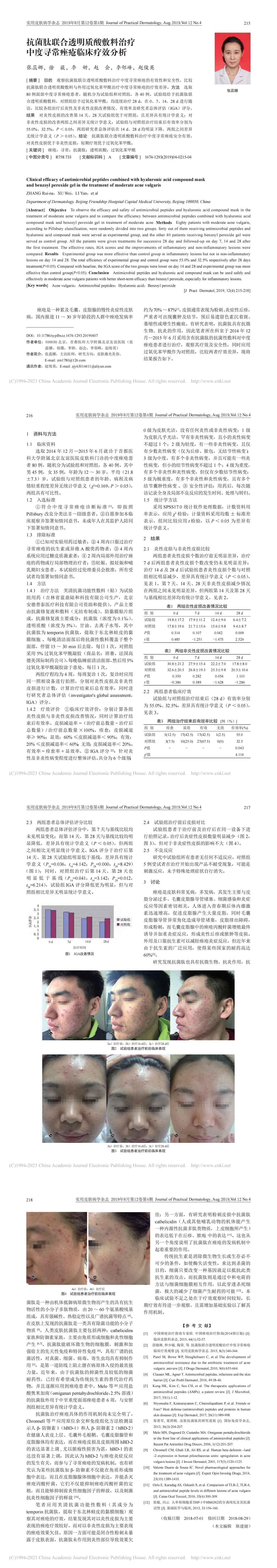 抗菌肽联合透明质酸敷料治疗中度寻常痤疮临床疗效分析
