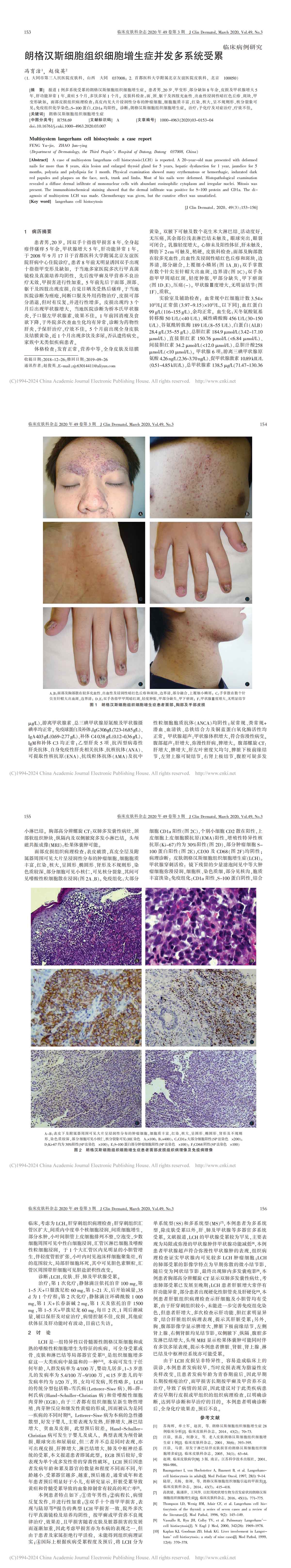 朗格汉斯细胞组织细胞增生症并发多系统受累