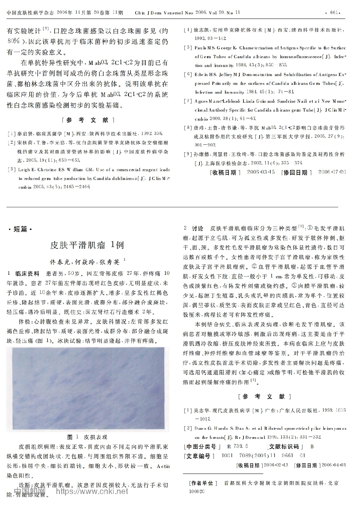 皮肤平滑肌瘤 1例