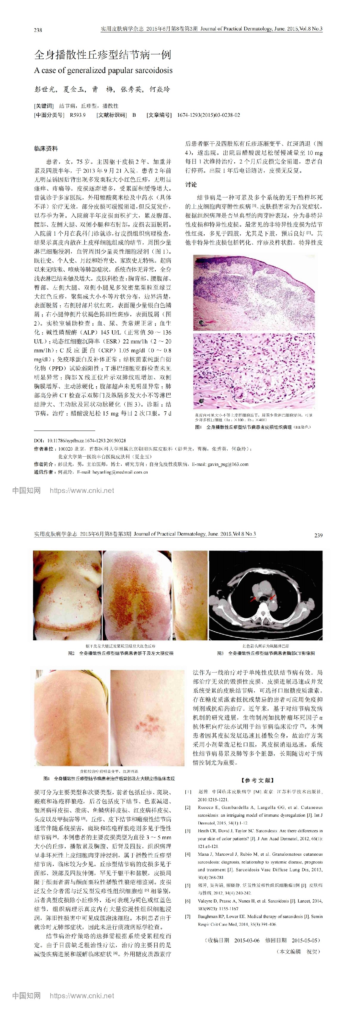 全身播散性丘疹型结节病一例