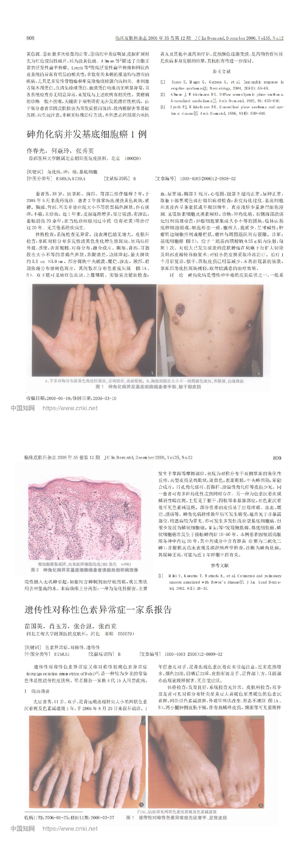 砷角化病并发基底细胞癌 1 例