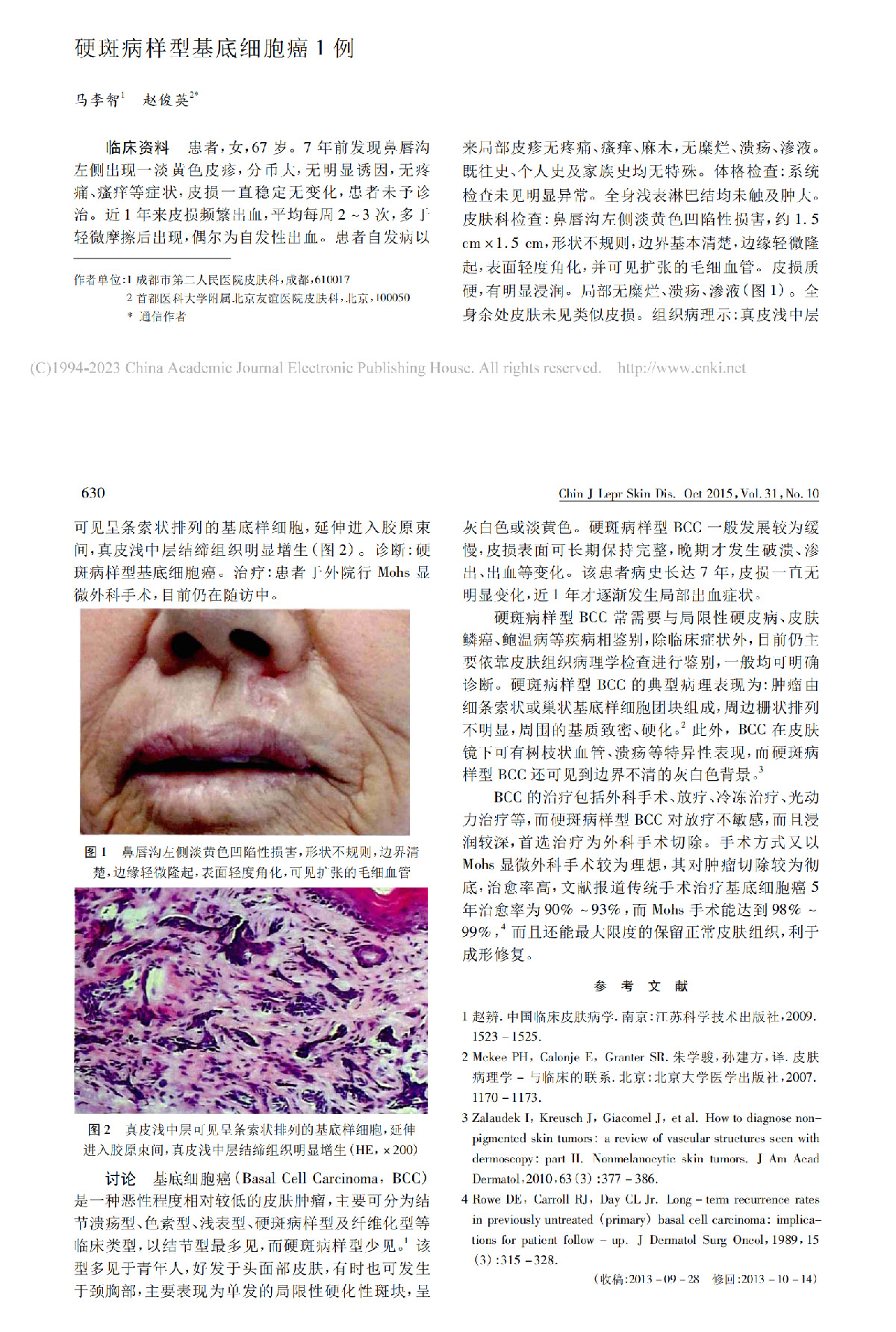 硬斑病样型基底细胞癌 1 例