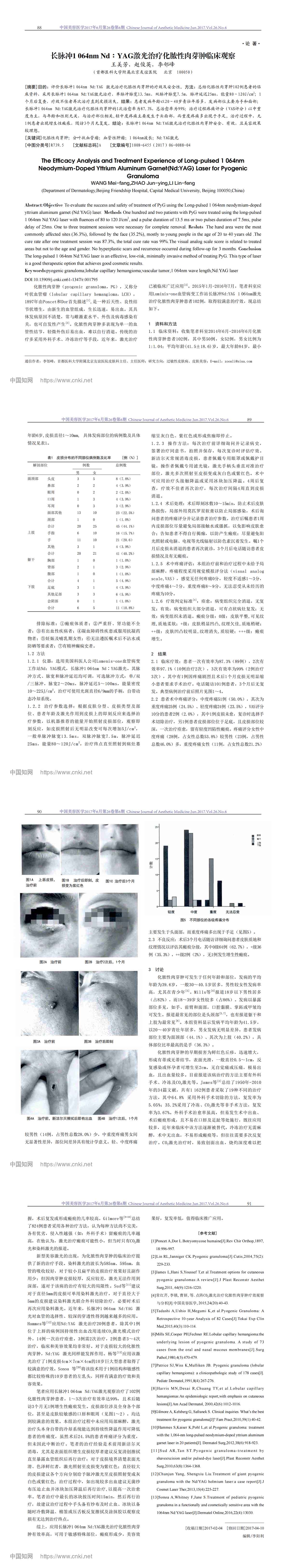 长脉冲1064nm Nd∶YAG激光治疗化脓性肉芽肿临床观察
