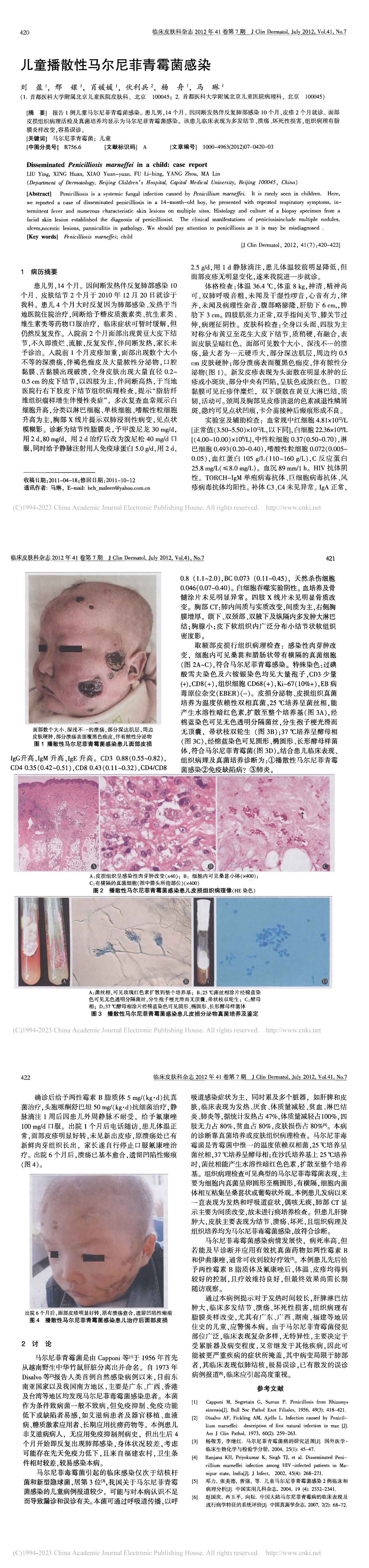 儿童播散性马尔尼菲青霉菌感染