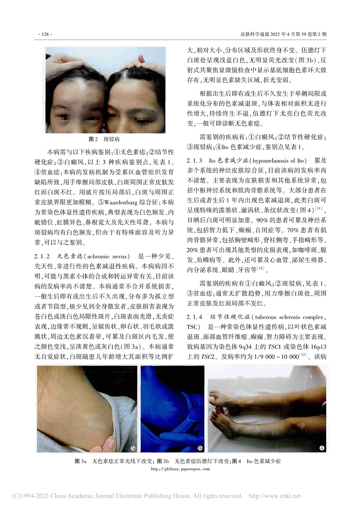 儿童色素减退性皮肤病的诊断