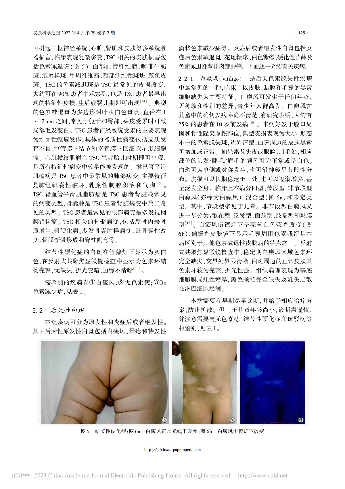 儿童色素减退性皮肤病的诊断