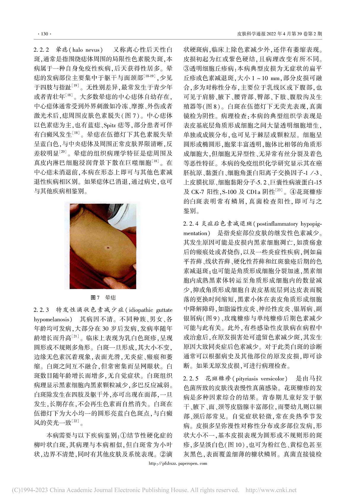 儿童色素减退性皮肤病的诊断