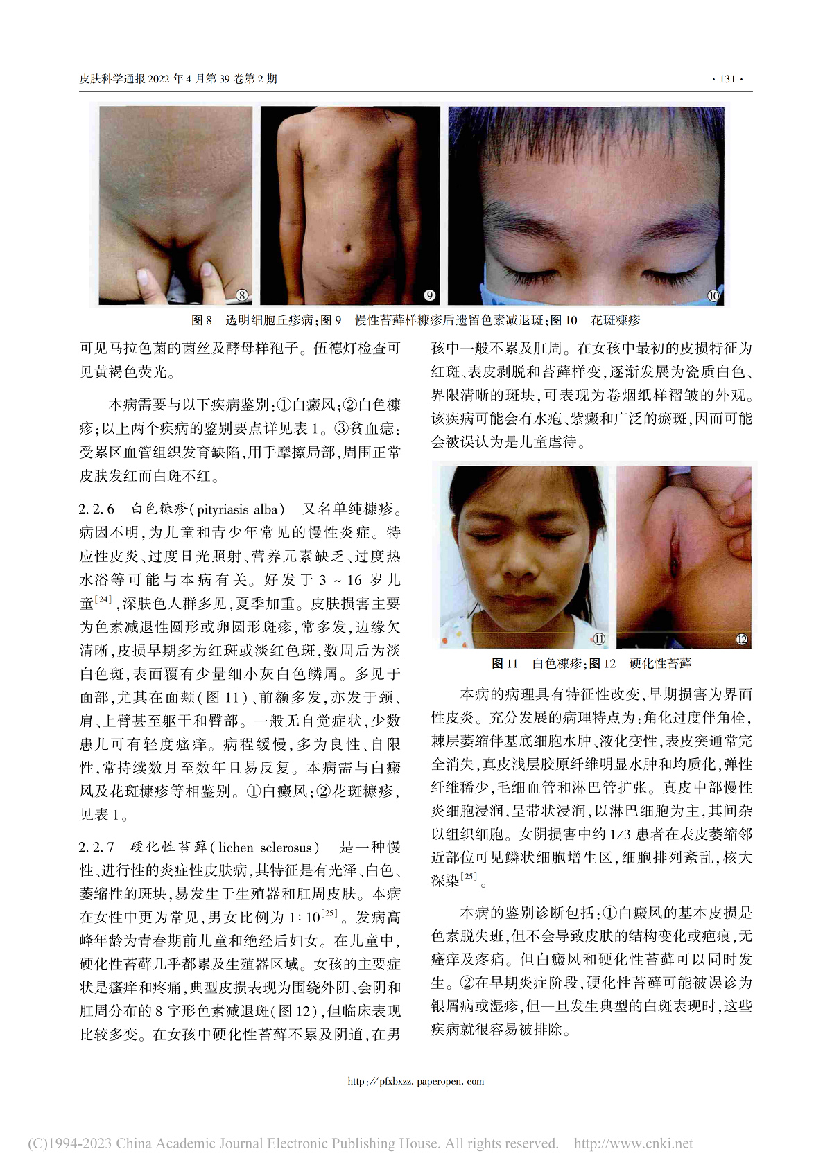 儿童色素减退性皮肤病的诊断
