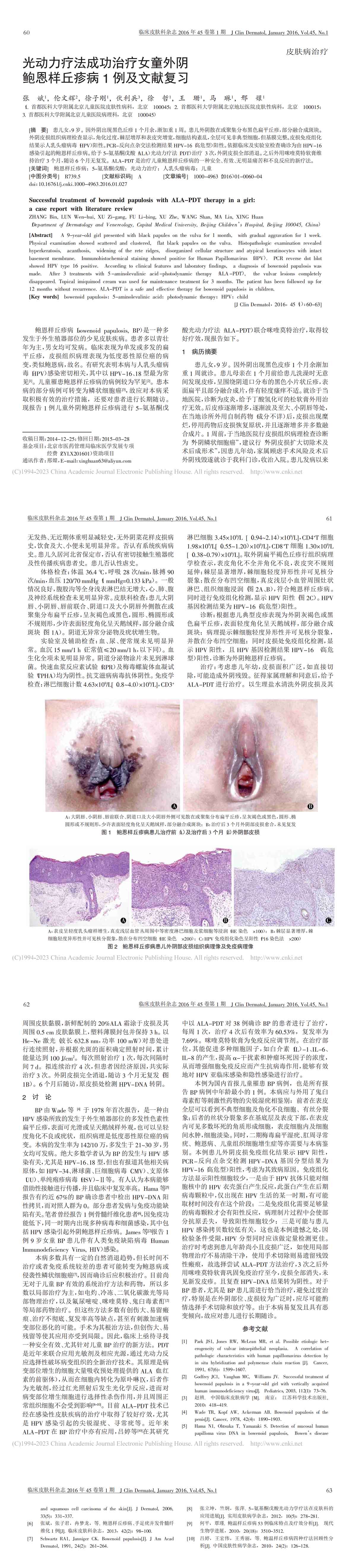 光动力疗法成功治疗女童外阴鲍恩样丘疹病1例及文献复习