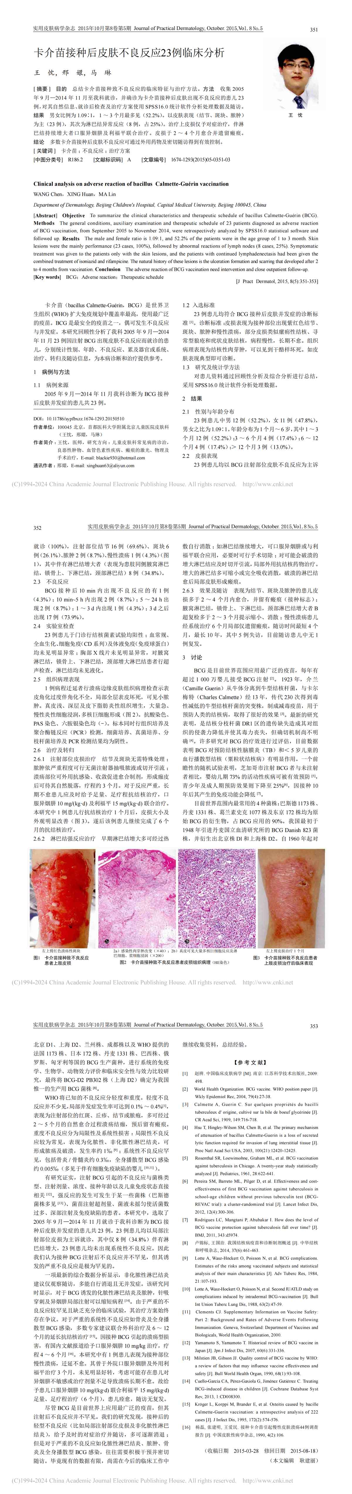 卡介苗接种后皮肤不良反应23例临床分析