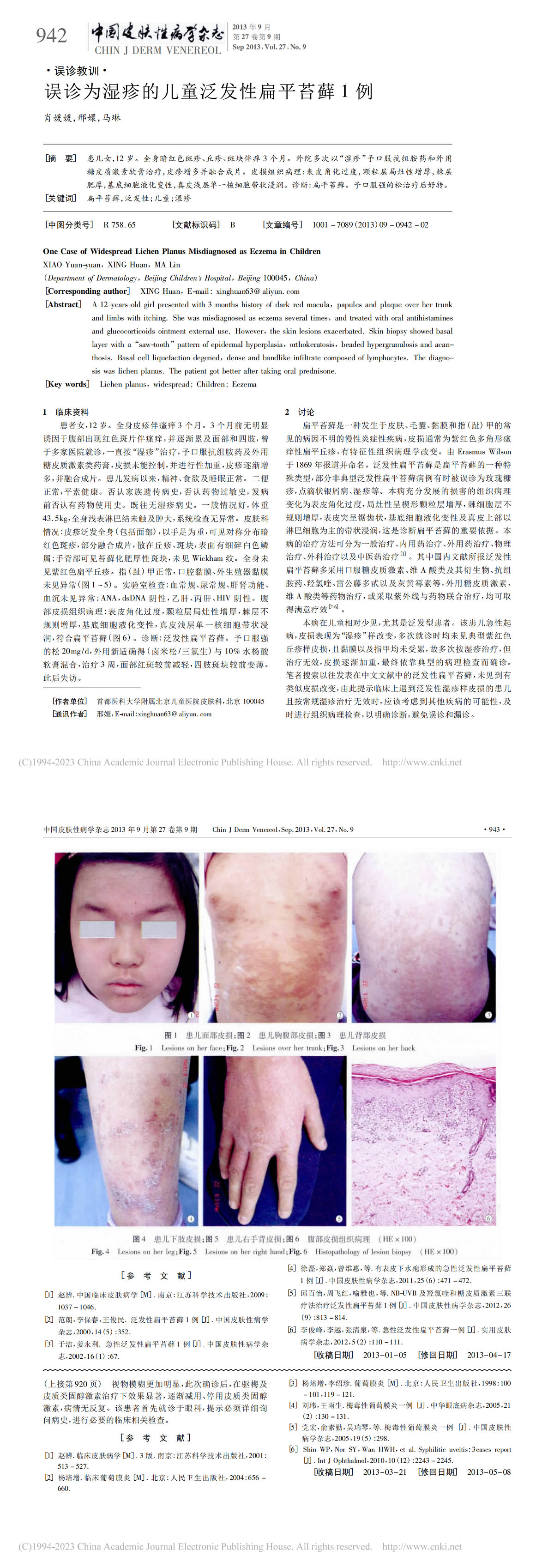 误诊为湿疹的儿童泛发性扁平苔藓 1 例