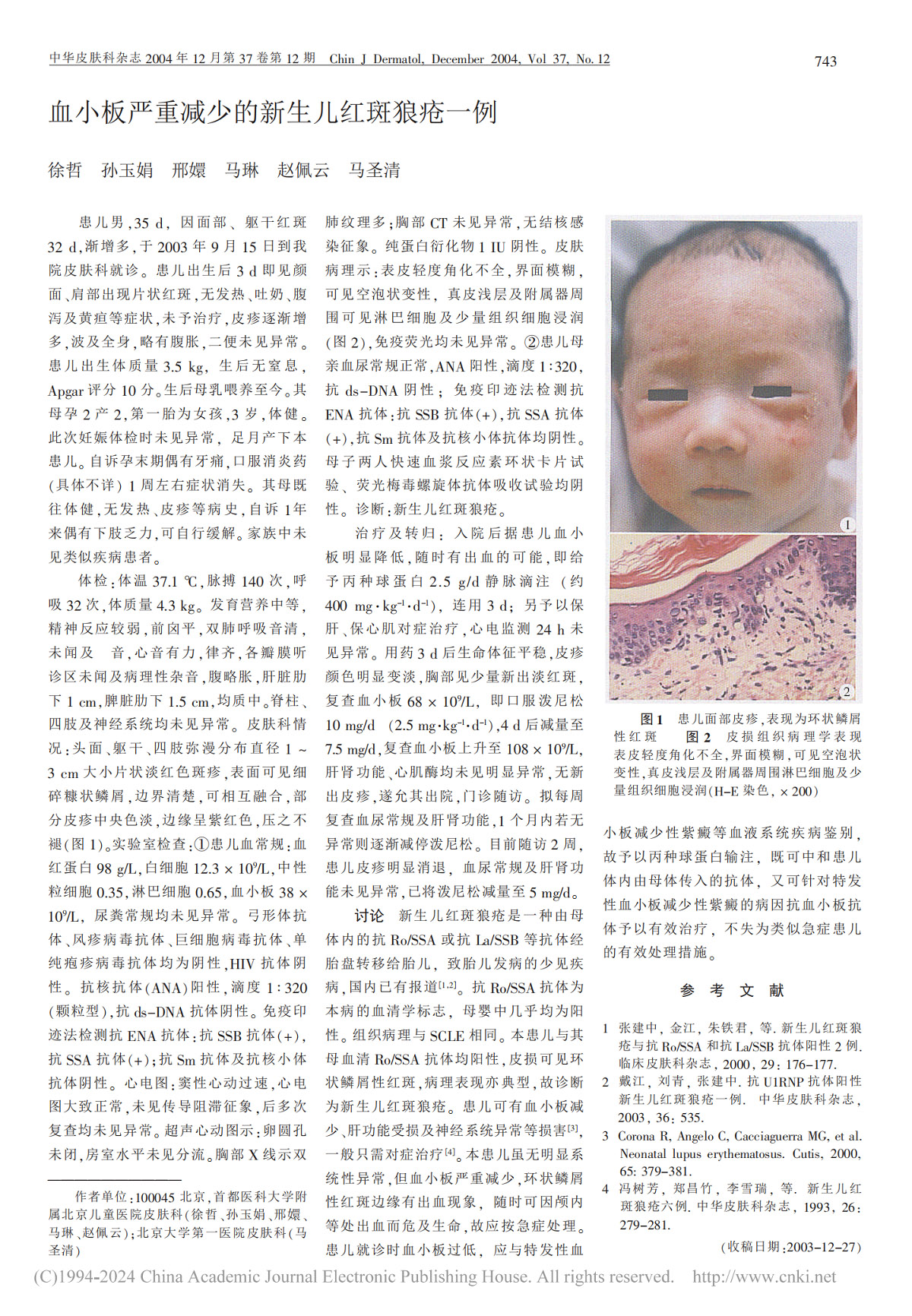 血小板严重减少的新生儿红斑狼疮一例