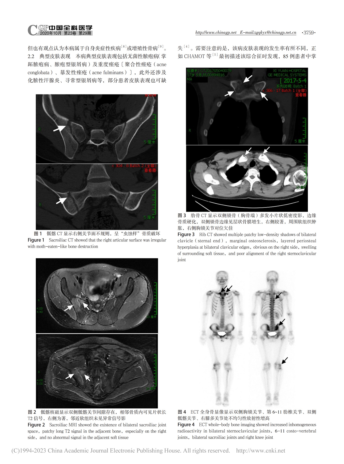 痤疮型SAPHO综合征一例诊治分析及文献复习