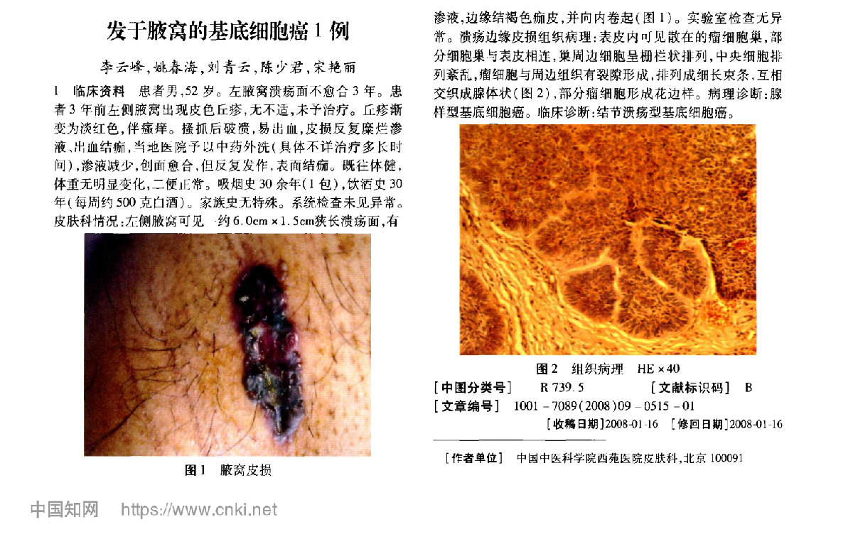 发于腋窝的基底细胞癌1例