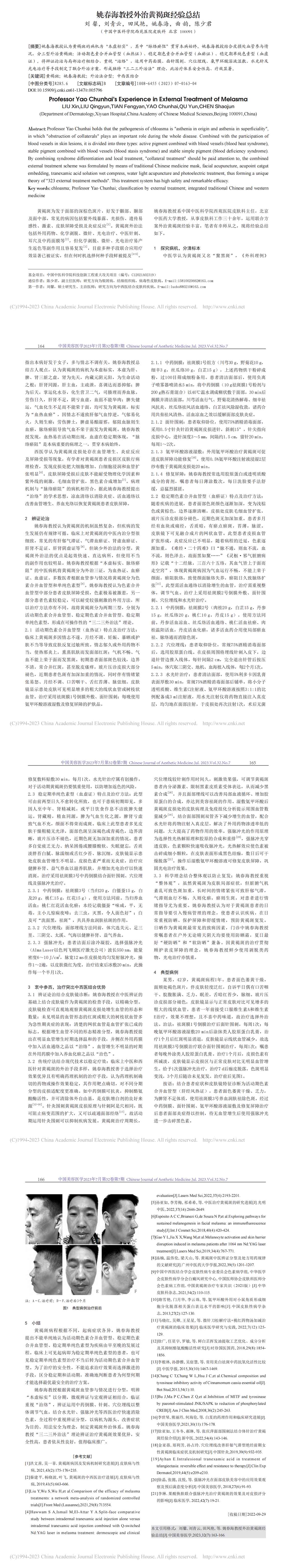 姚春海教授外治黄褐斑经验总结