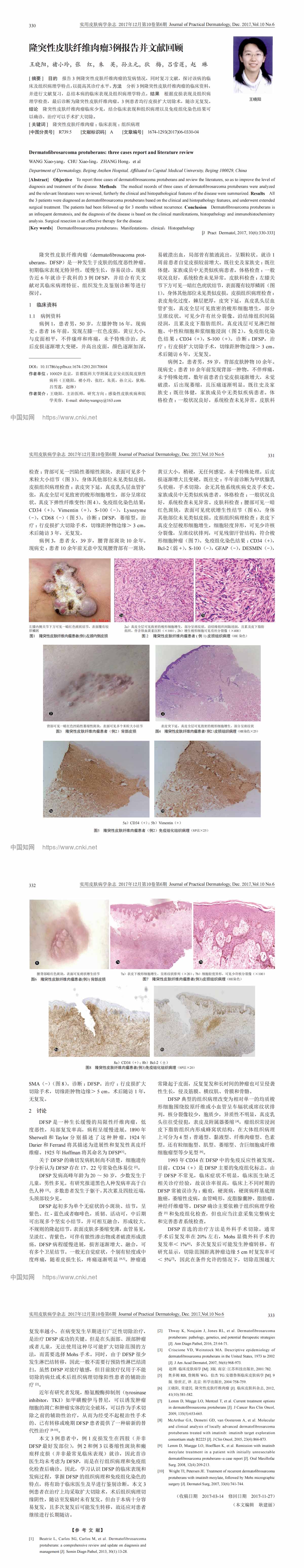 隆突性皮肤纤维肉瘤3例报告并文献回顾