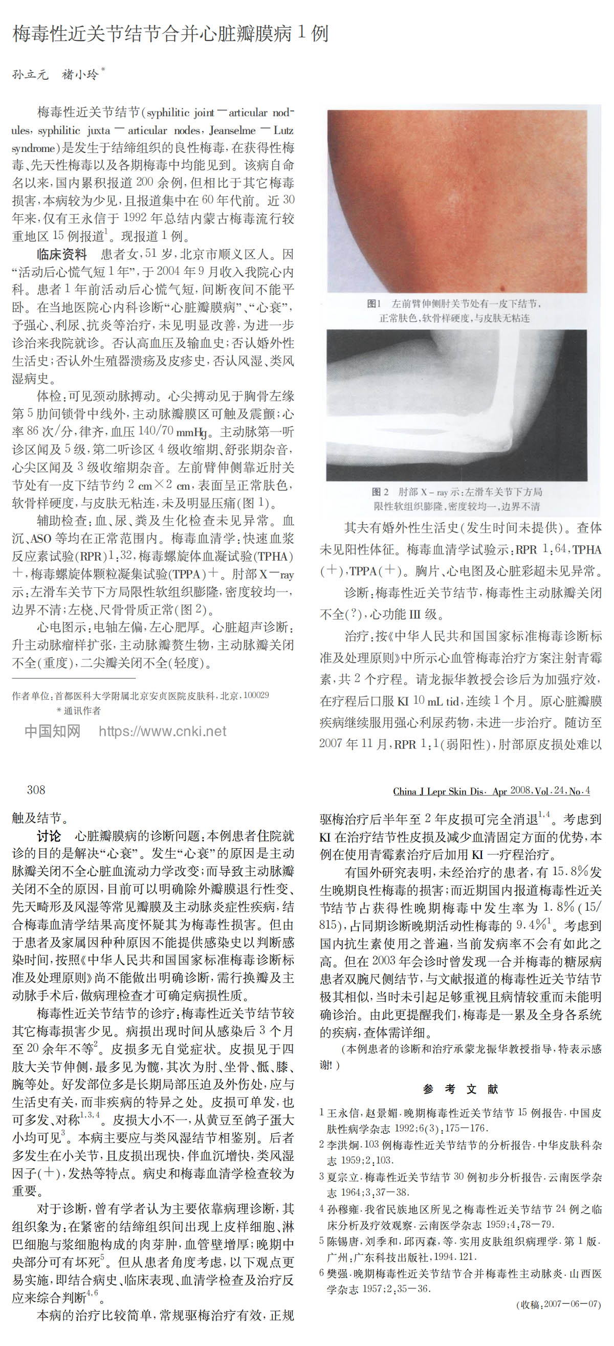 梅毒性近关节结节合并心脏瓣膜病1例