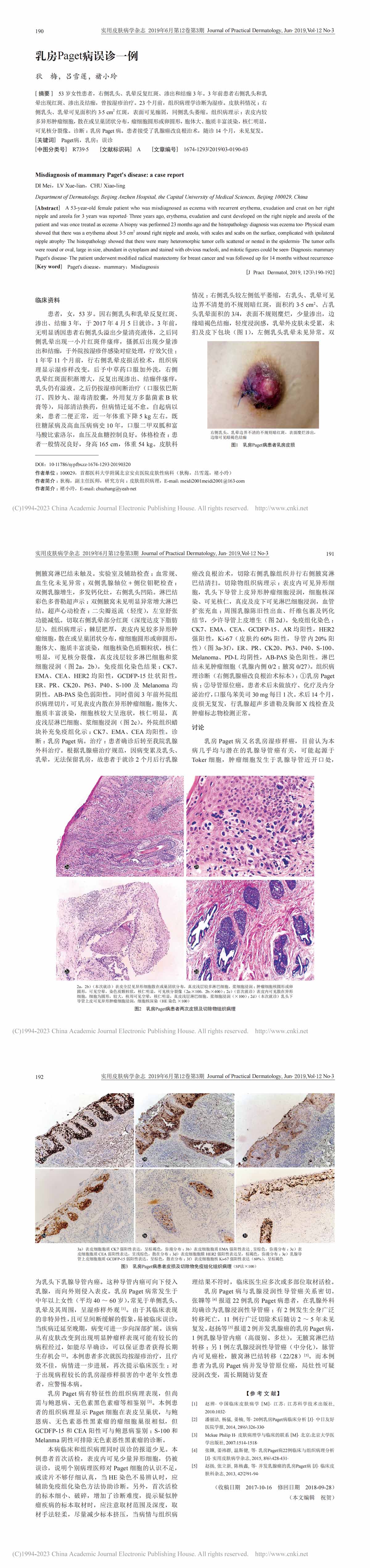 乳房Paget病误诊一例