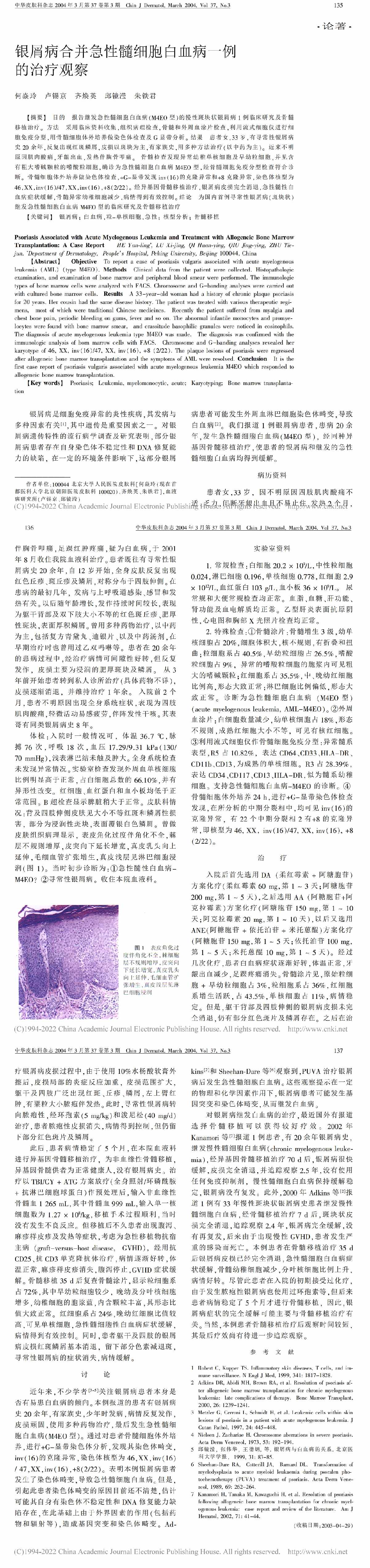 银屑病合并急性髓细胞白血病一例的治疗观察