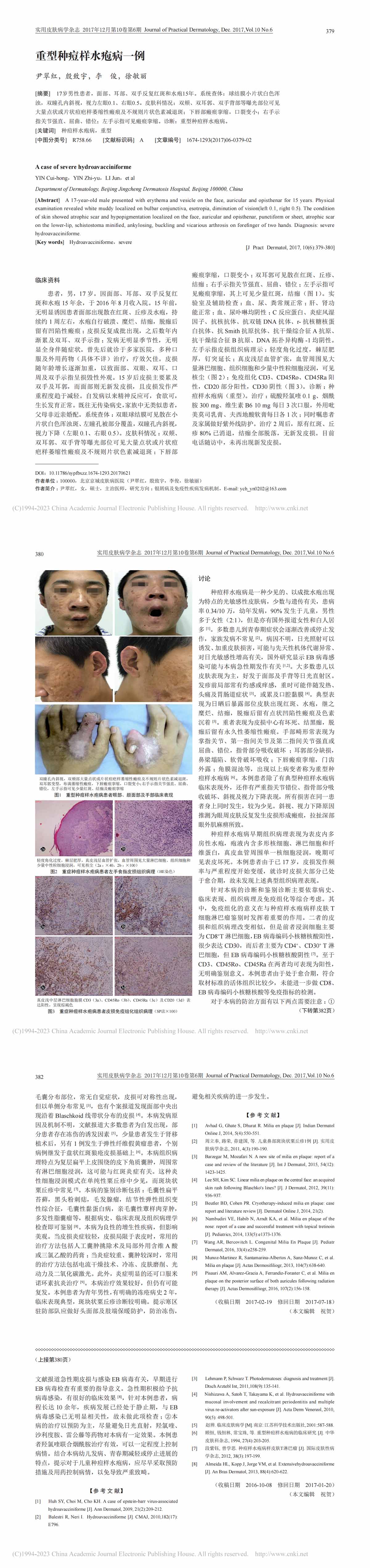 重型种痘样水疱病一例