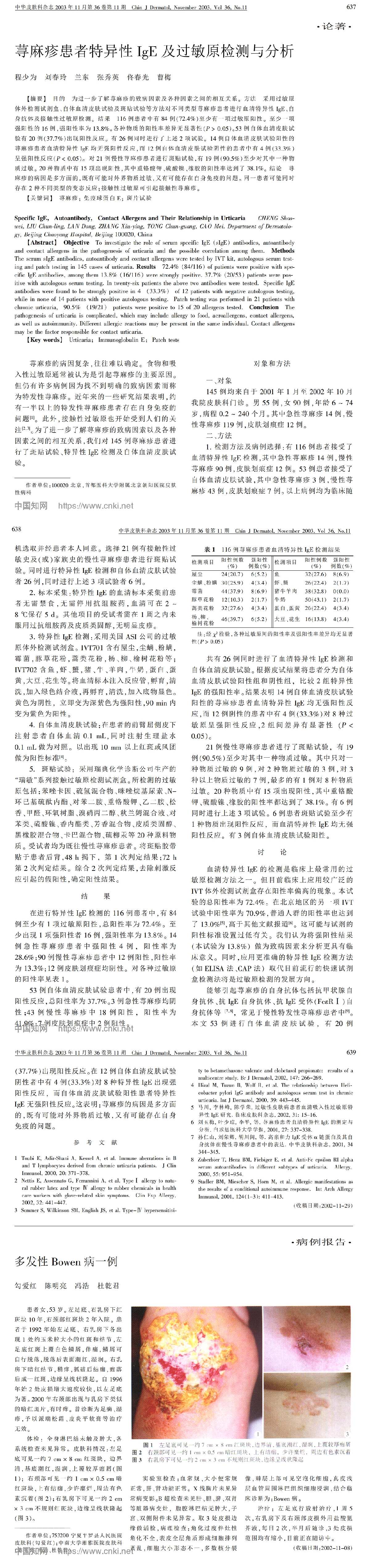 荨麻疹患者特异性IgE及过敏原检测与分析