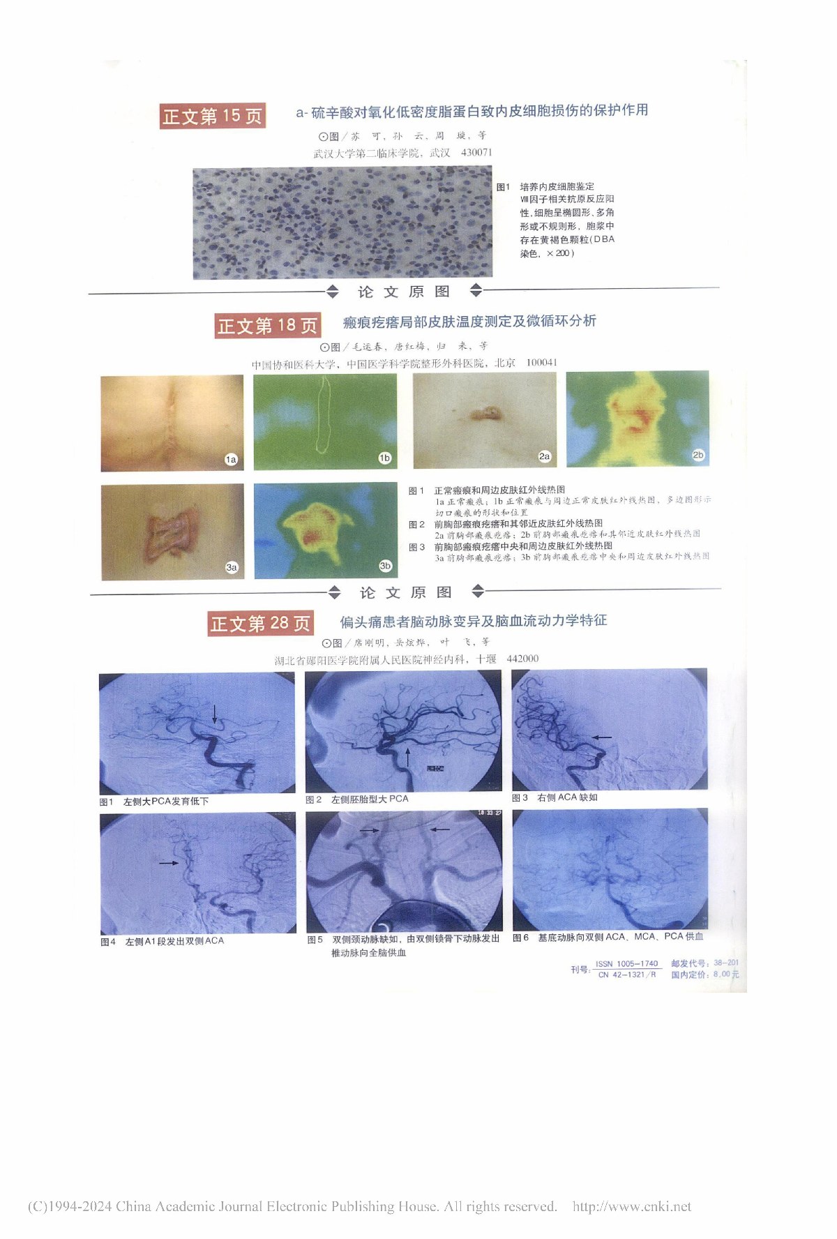 瘢痕疙瘩局部皮肤温度测定及微循环分析