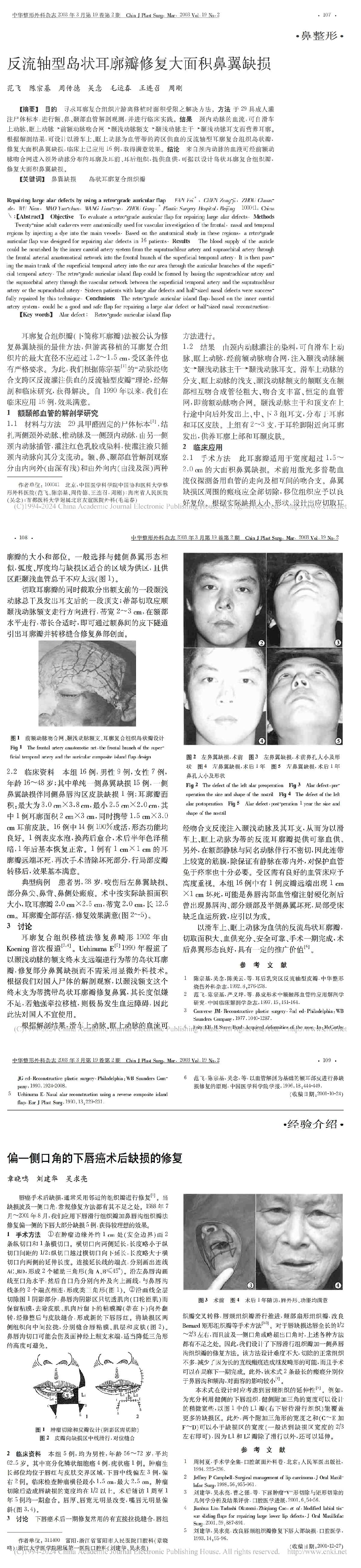反流轴型岛状耳廓瓣修复大面积鼻翼缺损