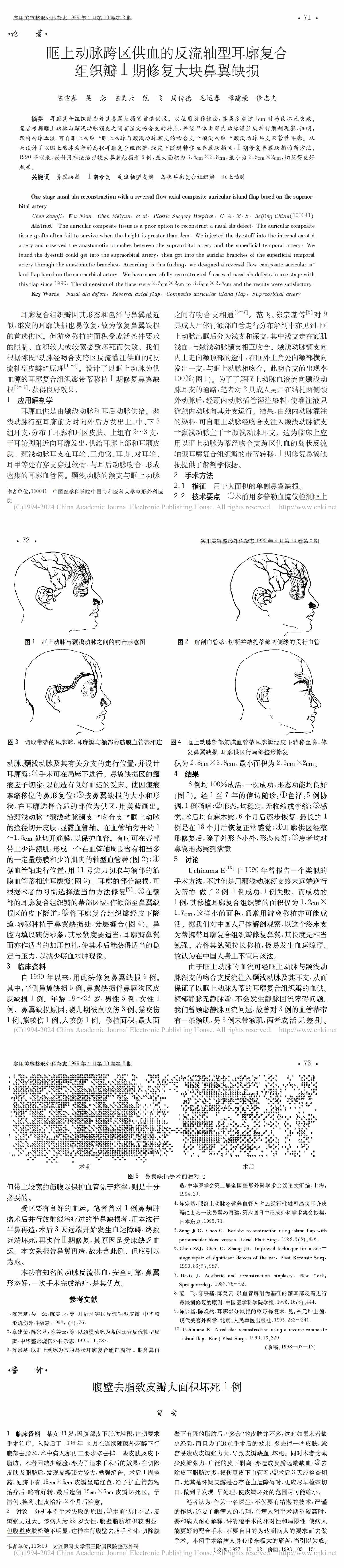 眶上动脉跨区供血的反流轴型耳廓复合组织瓣Ⅰ期修复大块鼻翼缺损