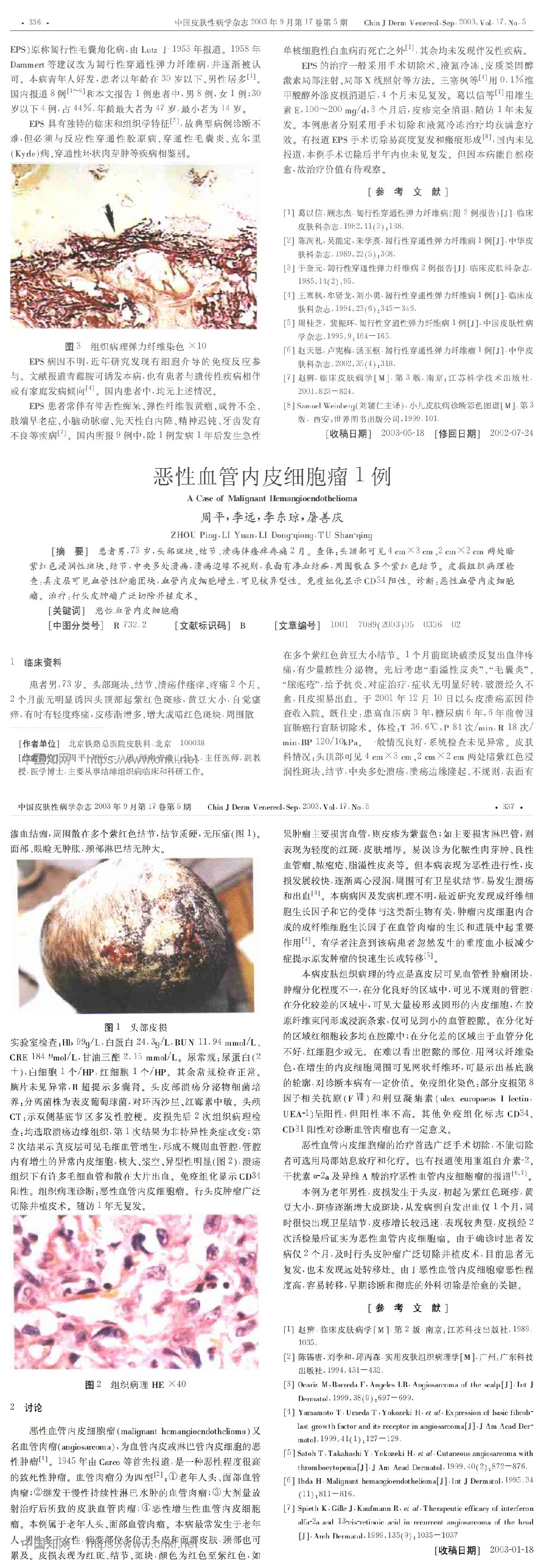 恶性血管内皮细胞瘤1例