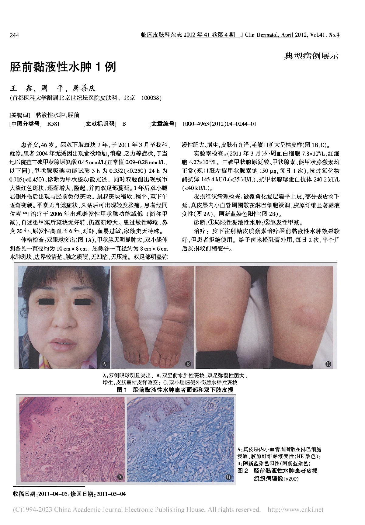 胫前黏液性水肿1例
