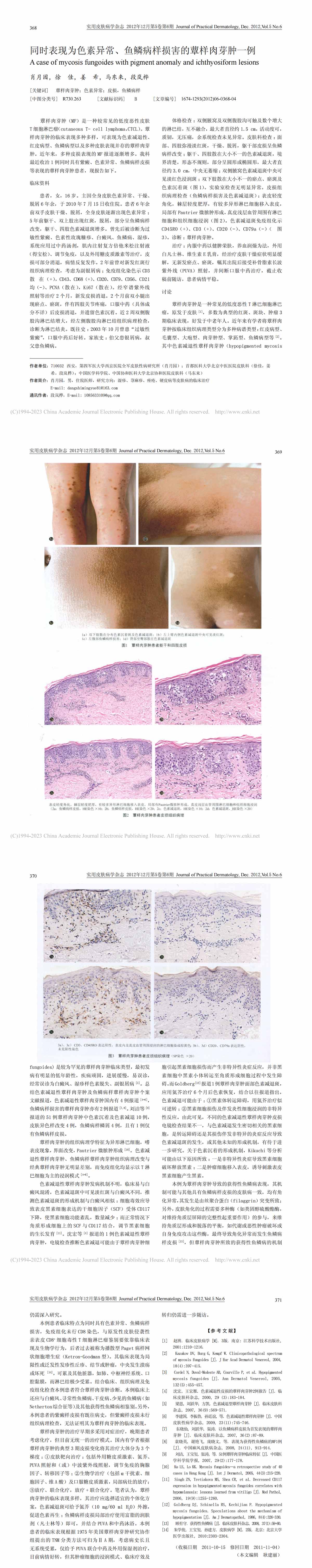 同时表现为色素异常、鱼鳞病样损害的蕈样肉芽肿一例