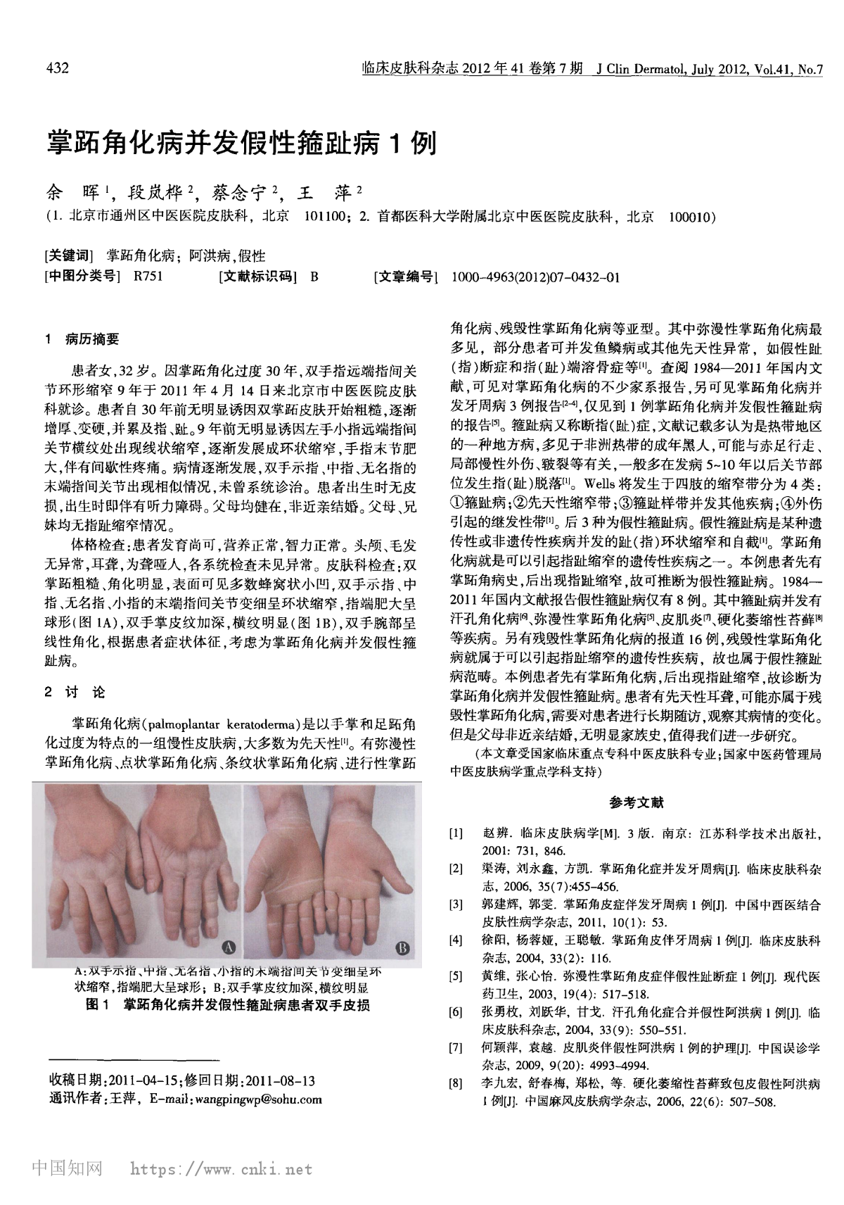 掌拓角化病并发假性箍趾病 1 例
