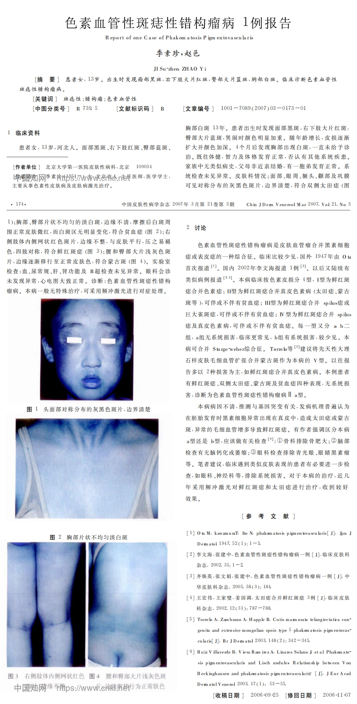 色素血管性斑痣性错构瘤病1例报告