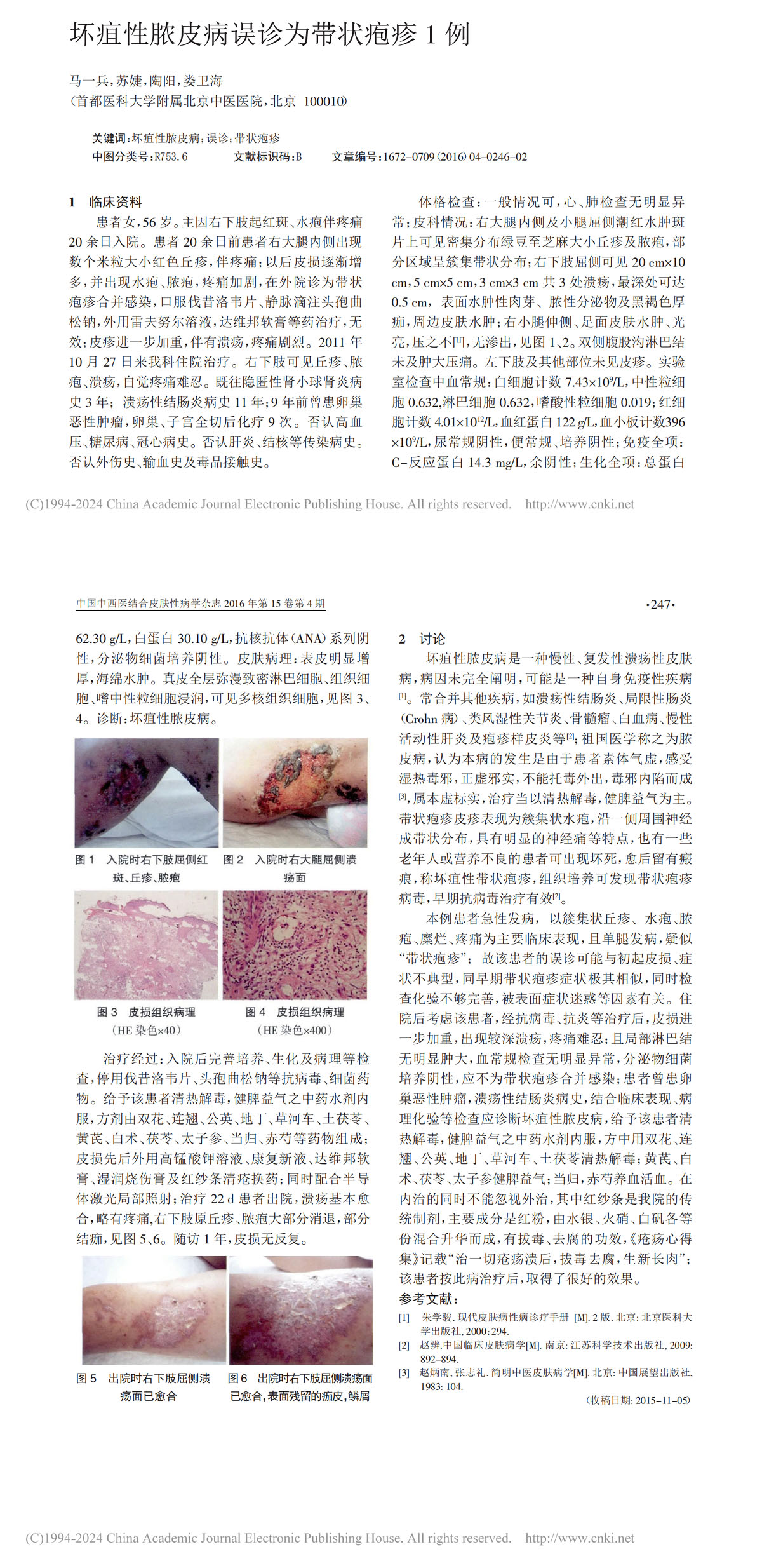 坏疽性脓皮病误诊为带状疱疹 1 例