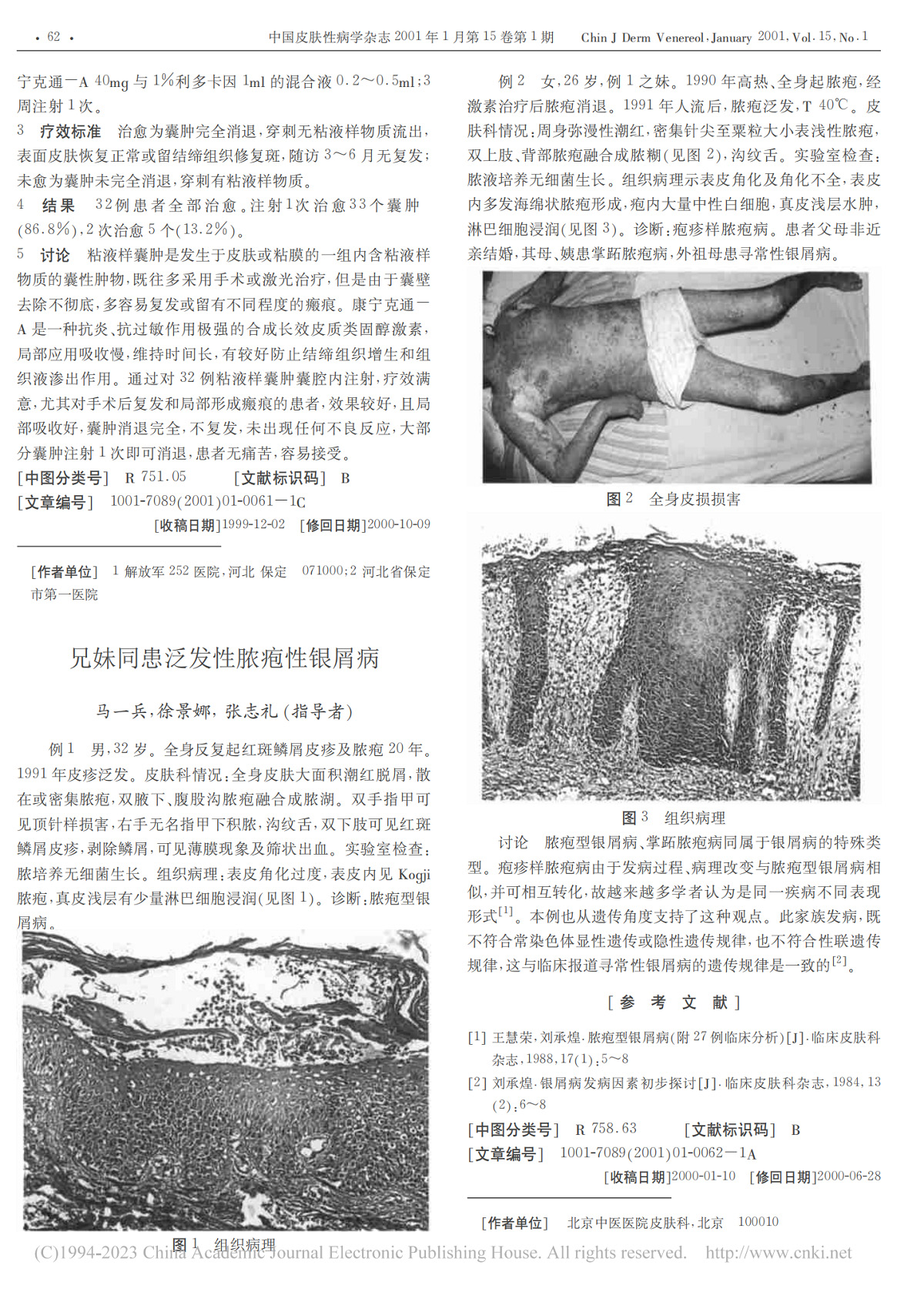 兄妹同患泛发性脓疱性银屑病