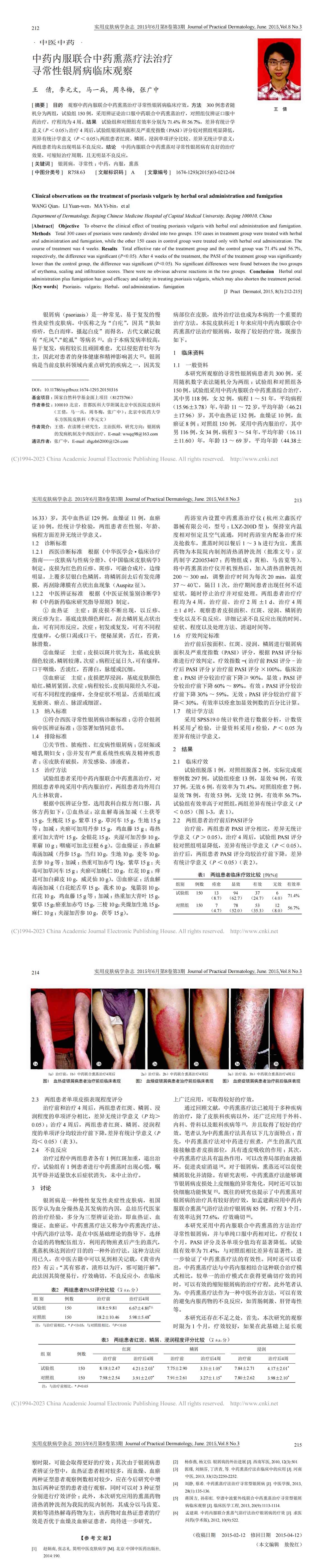 中药内服联合中药熏蒸疗法治疗寻常性银屑病的临床观察