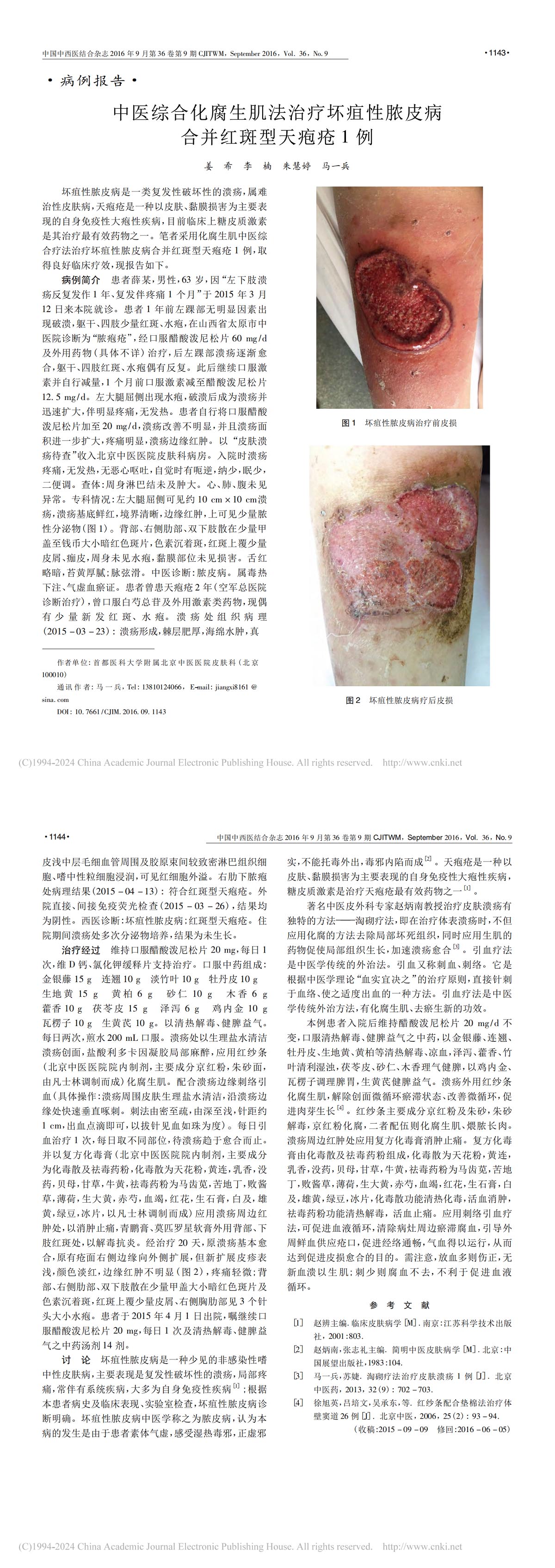 中医综合化腐生肌法治疗坏疽性脓皮病