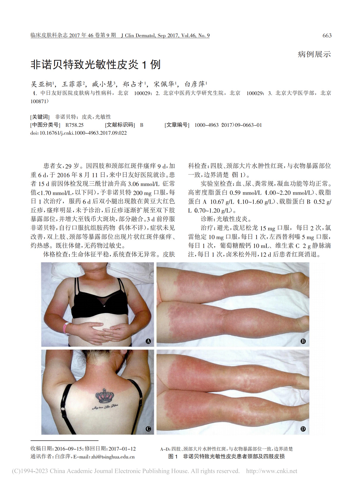 非诺贝特致光敏性皮炎 1 例