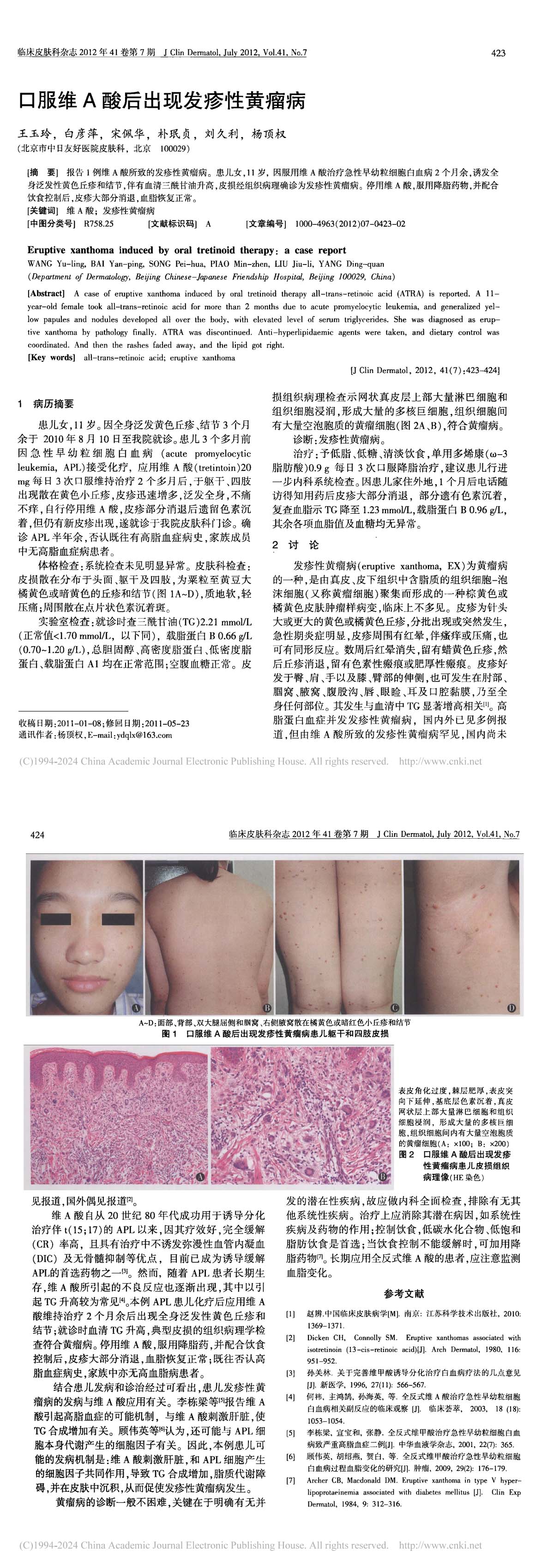 口服维A酸后出现发疹性黄瘤病