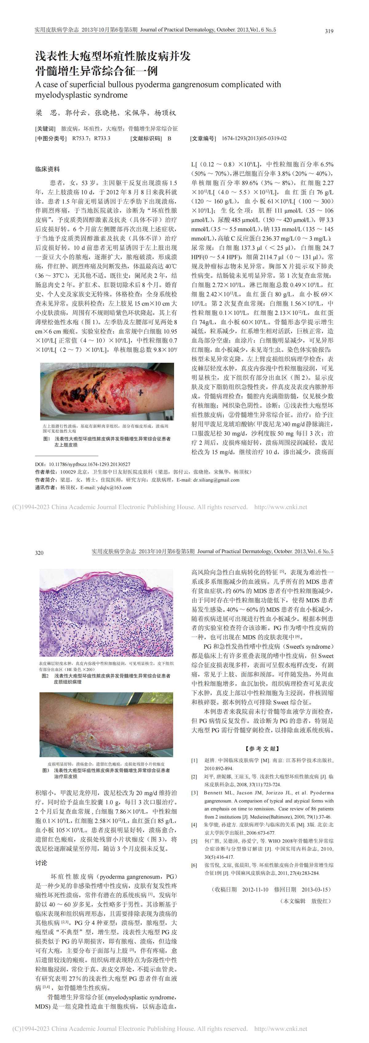 浅表性大疱型坏疽性脓皮病并发骨髓增生异常综合征一例