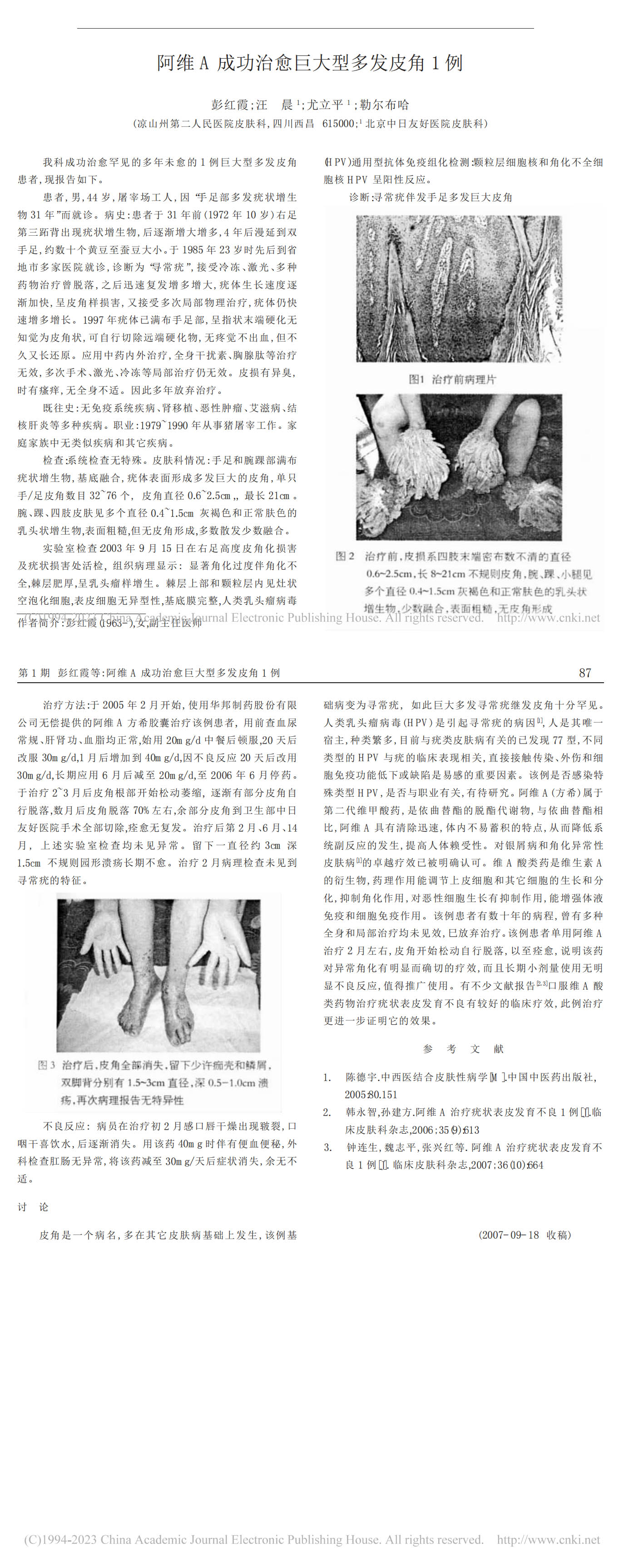 阿维 A 成功治愈巨大型多发皮角 1 例