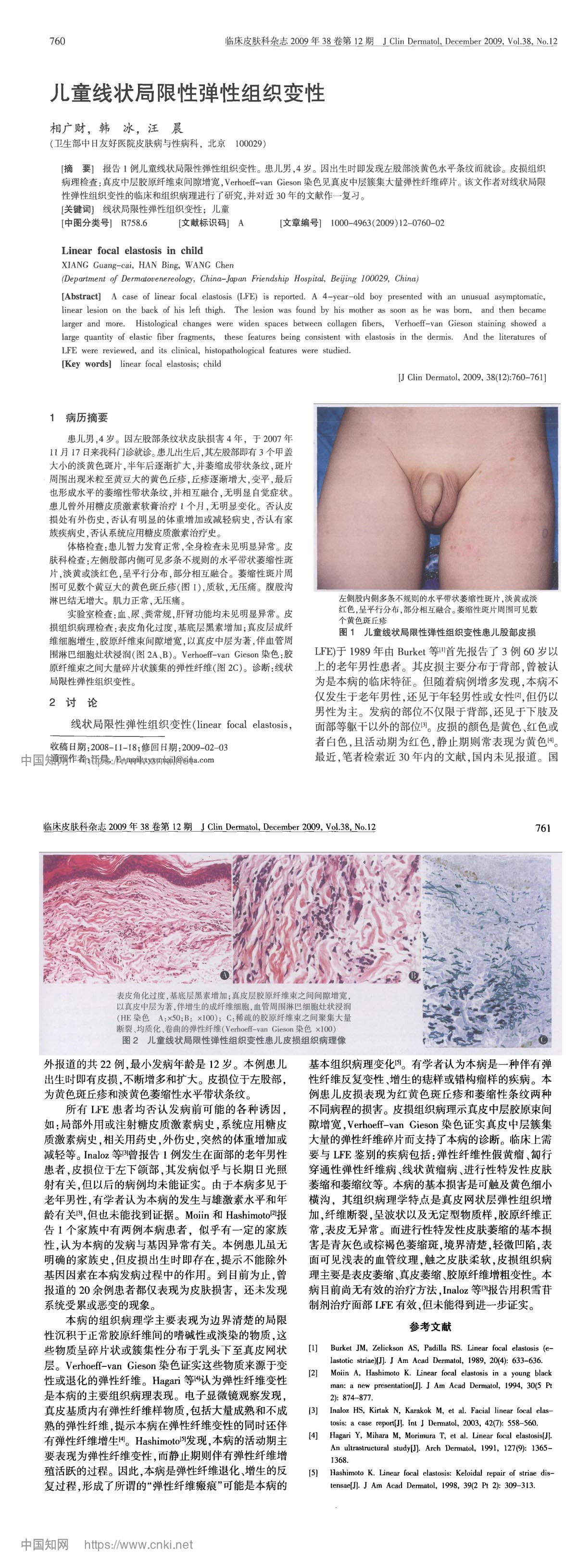 儿童线状局限性弹性组织变性