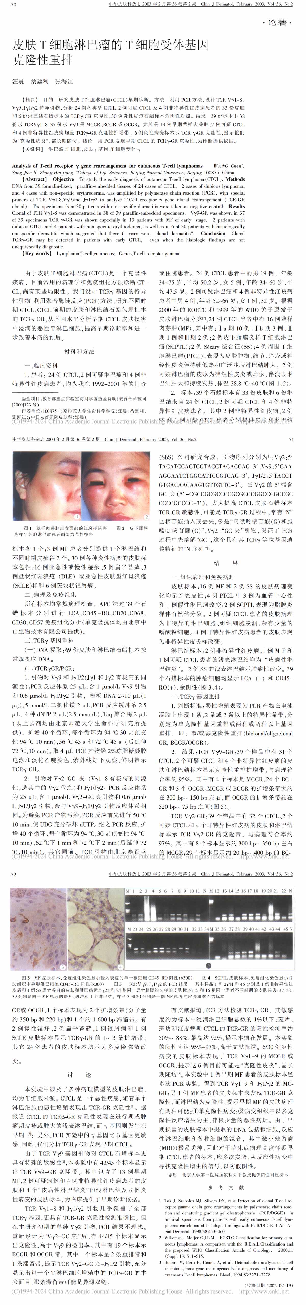 皮肤T细胞淋巴瘤的T细胞受体基因克隆性重排