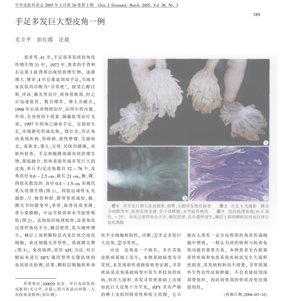 手足多发巨大型皮角一例