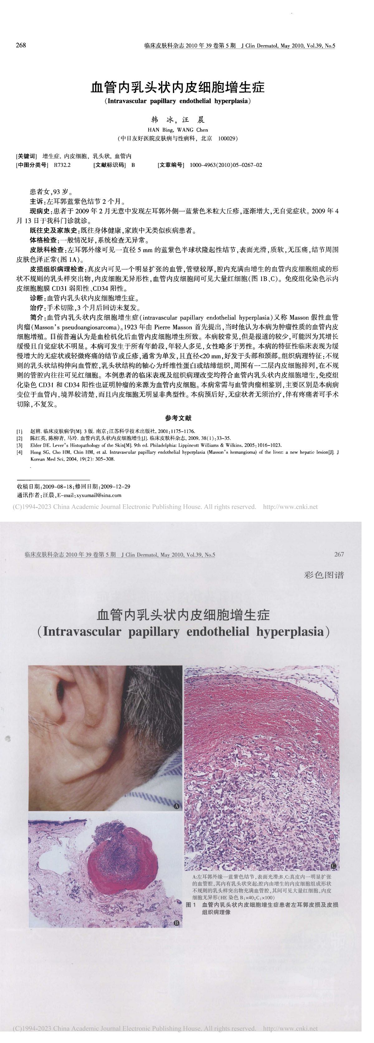 血管内乳头状内皮细胞增生症