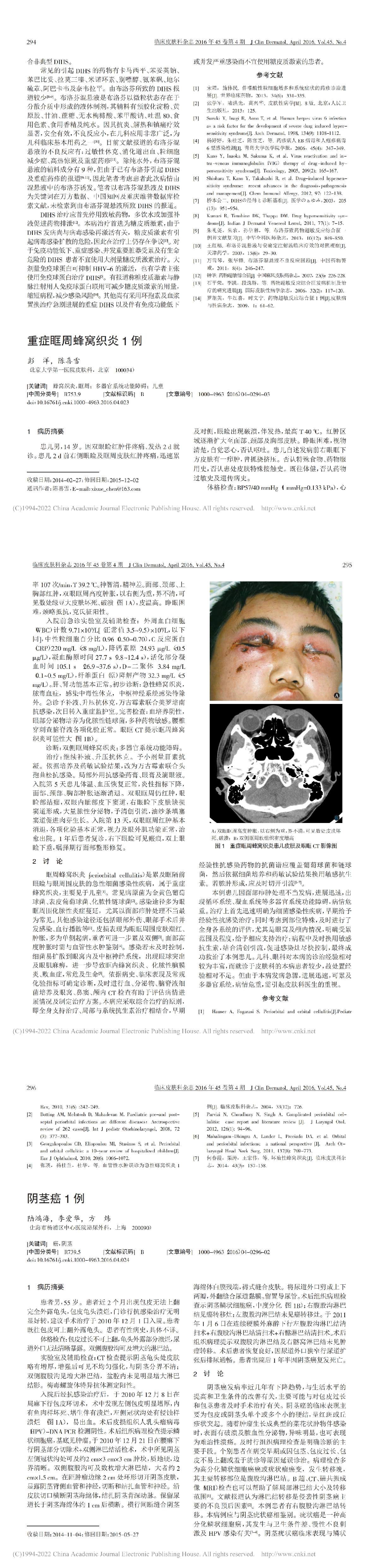 重症眶周蜂窝织炎1例