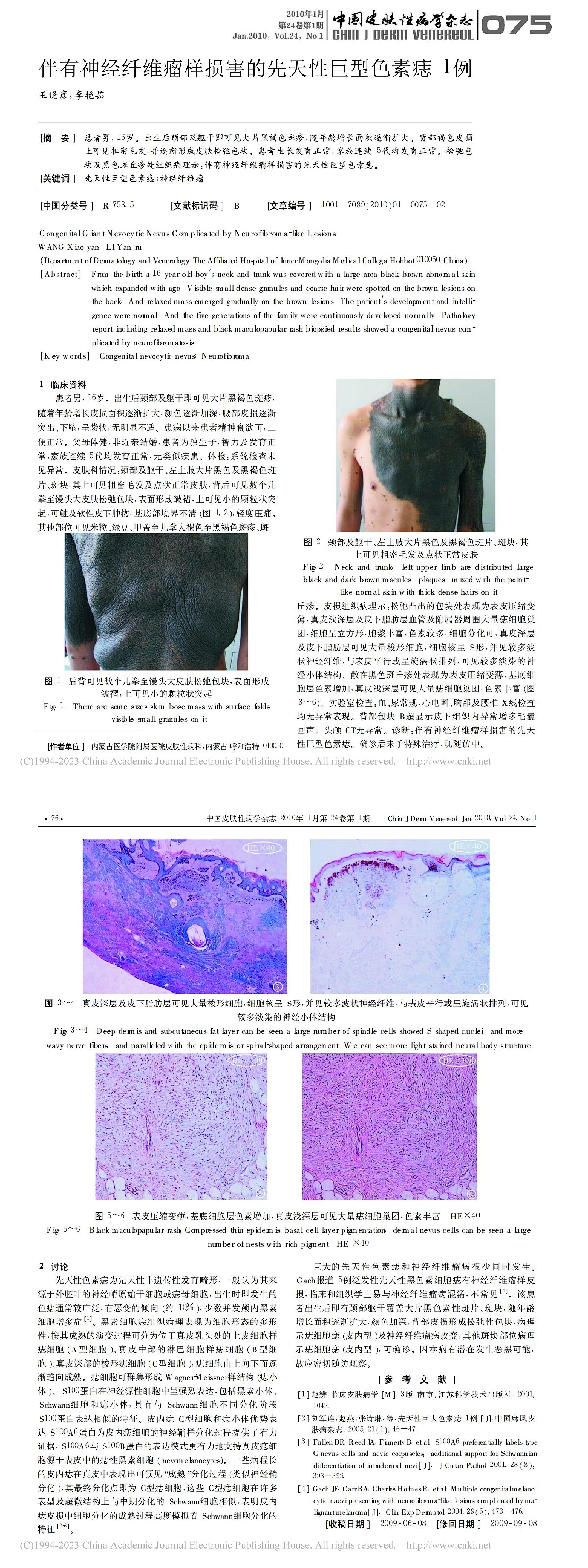 伴有神经纤维瘤样损害的先天性巨型色素痣1例