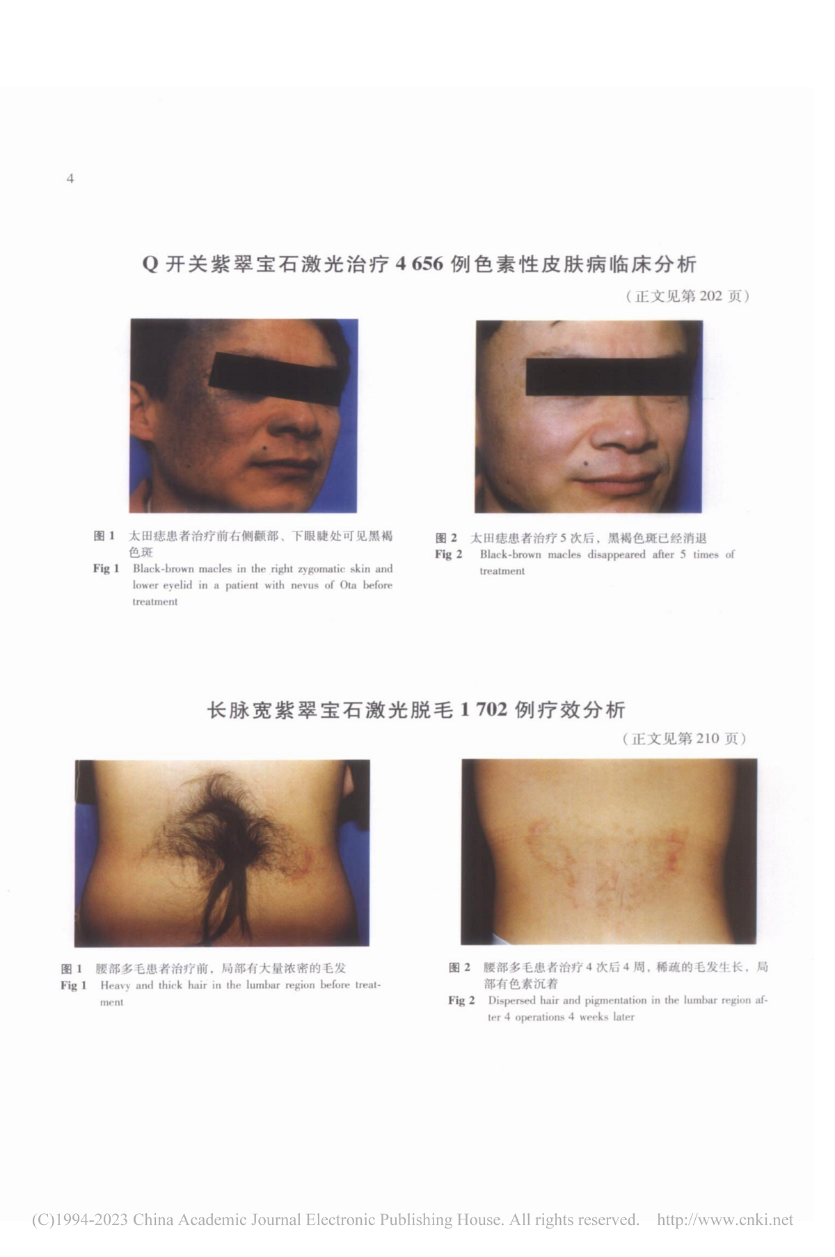 Ｑ开关紫翠宝石激光治疗4656例色素性皮肤病临床分析