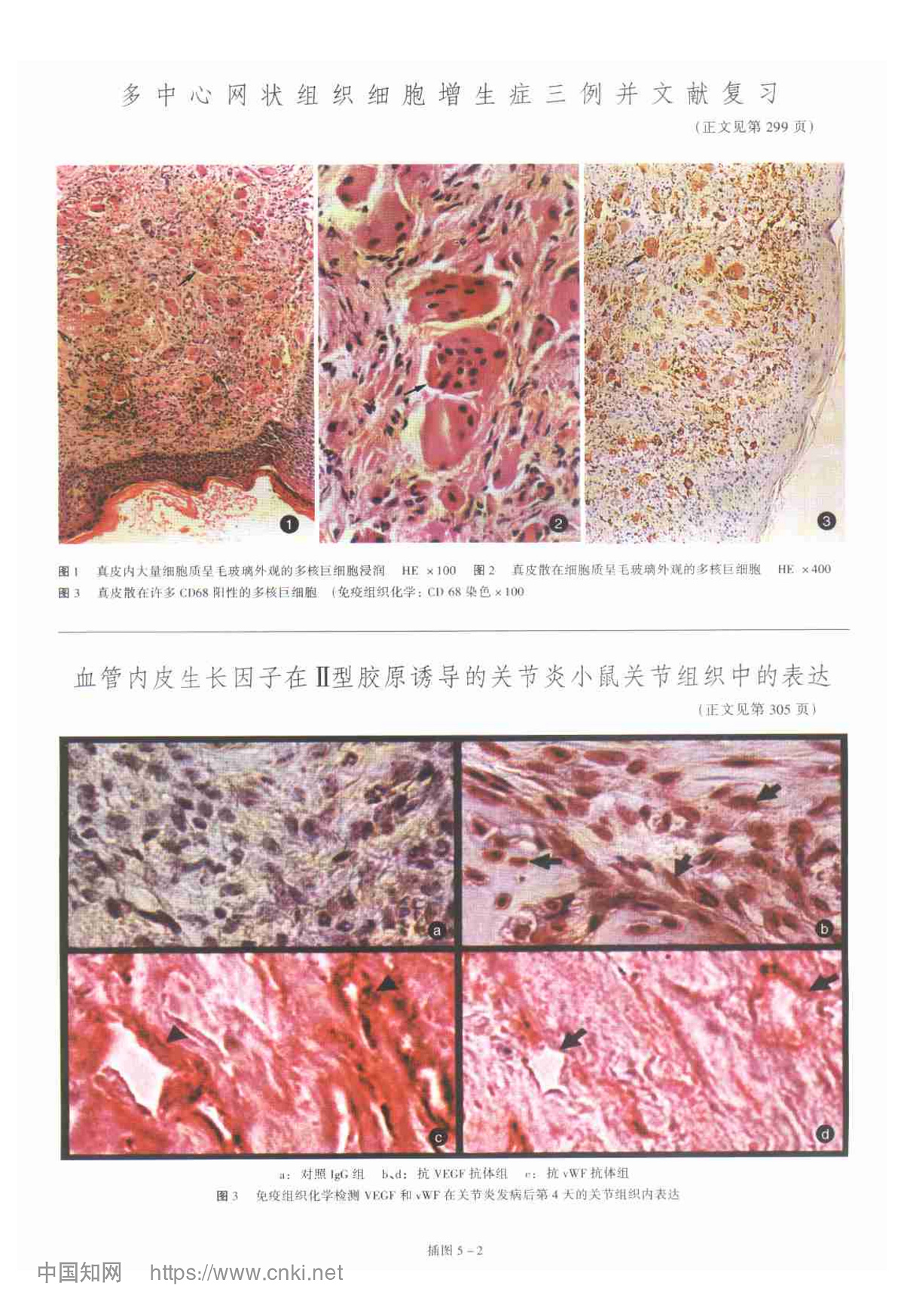 多中心网状组织细胞增生症三例并文献复习